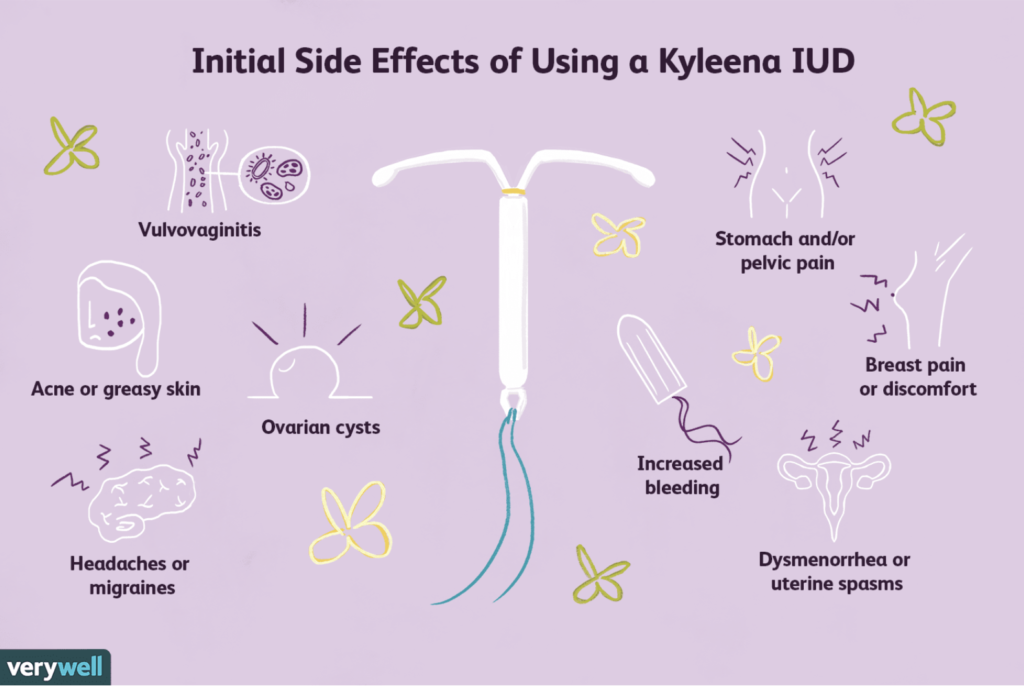 Kyleena Intrauterine Device - English | Domus Læknar